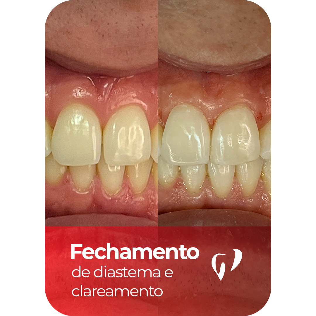 Resultado - Disatema e Clareamento