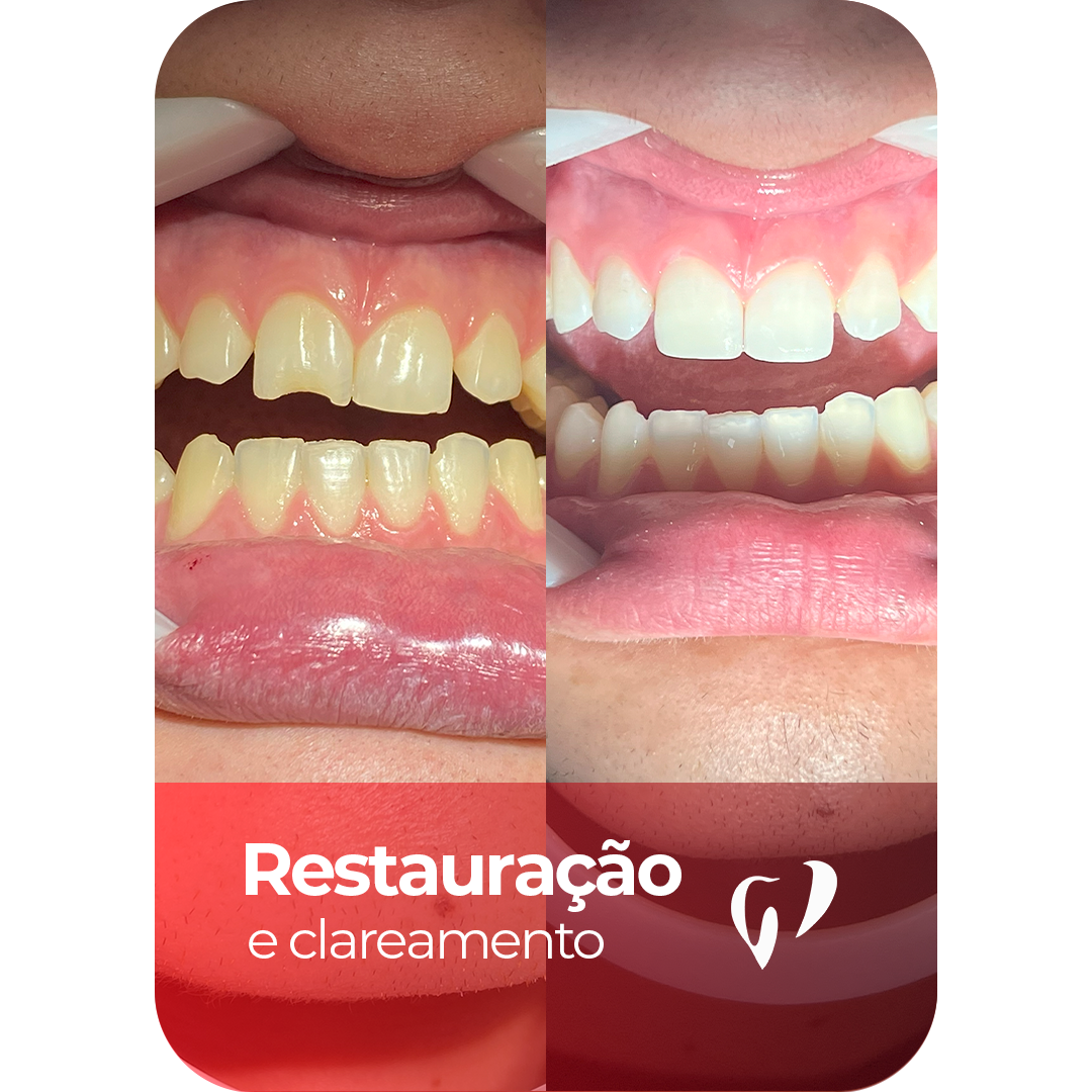 Resultado - Restauração e clareamento